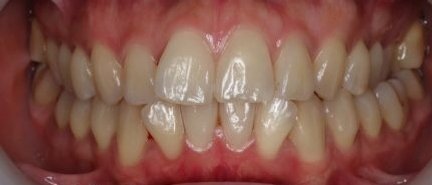 Invisalign Straightening Teeth