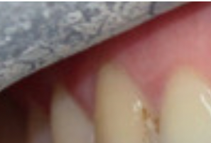 Dentist Internal Teeth Whitening Bleaching