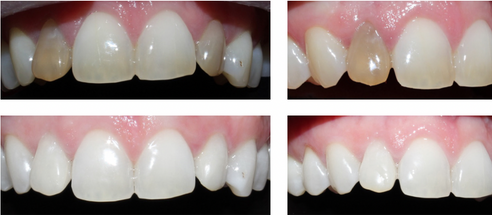 Dentist Internal Teeth Whitening Bleaching 